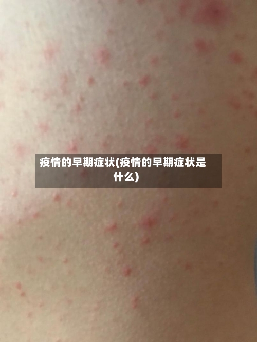 疫情的早期症状(疫情的早期症状是什么)-第3张图片