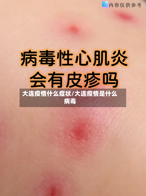 大连疫情什么症状/大连疫情是什么病毒-第2张图片