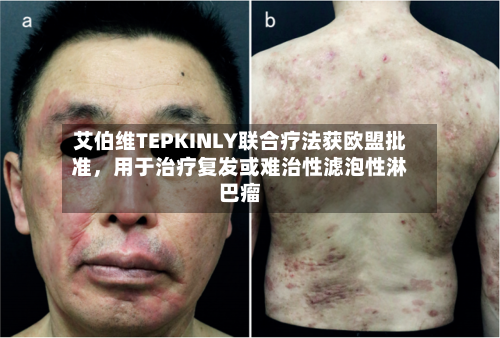艾伯维TEPKINLY联合疗法获欧盟批准	，用于治疗复发或难治性滤泡性淋巴瘤-第3张图片