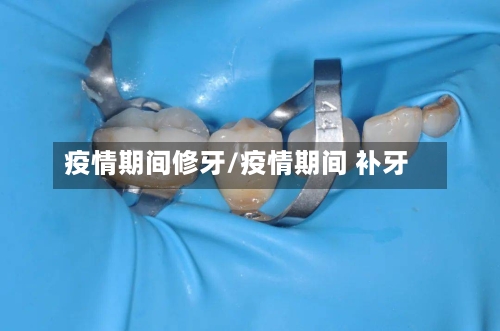 疫情期间修牙/疫情期间 补牙