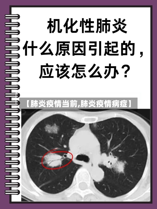 【肺炎疫情当前,肺炎疫情病症】-第2张图片