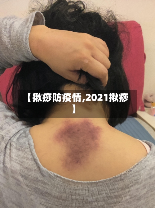 【揪痧防疫情,2021揪痧】-第3张图片