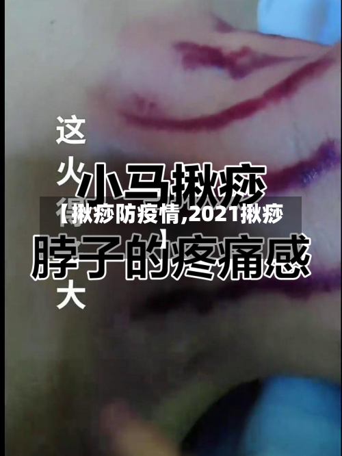 【揪痧防疫情,2021揪痧】-第2张图片