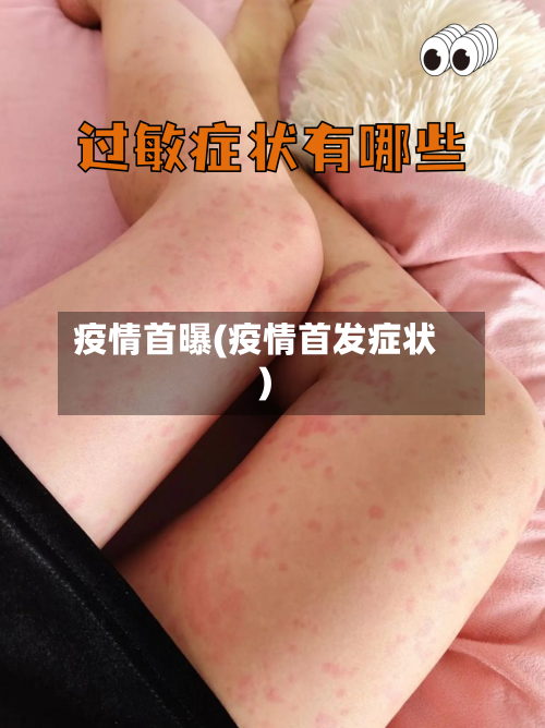 疫情首曝(疫情首发症状)-第2张图片