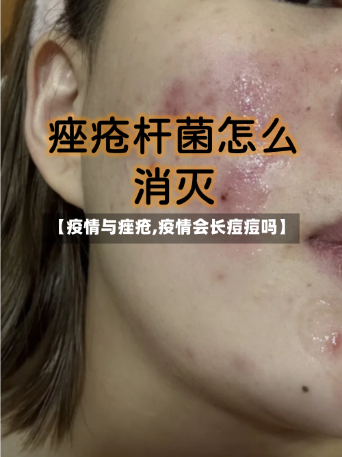 【疫情与痤疮,疫情会长痘痘吗】