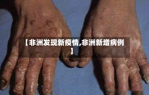 【非洲发现新疫情,非洲新增病例】