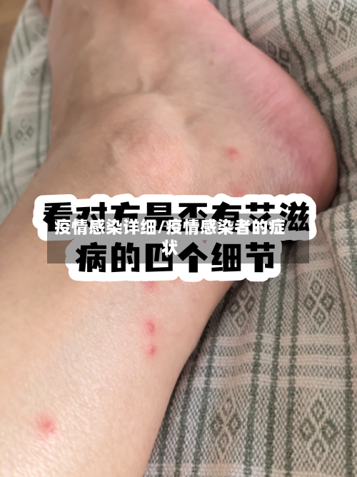 疫情感染详细/疫情感染者的症状