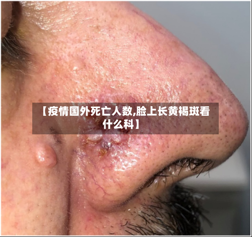 【疫情国外死亡人数,脸上长黄褐斑看什么科】-第2张图片